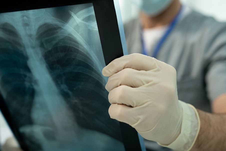 Fisioterapia a Roma Frattura delle costole - cosa fare e come guarire