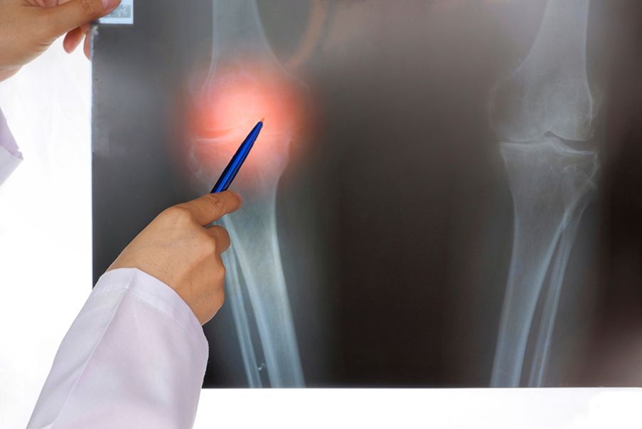 Fisioterapia a Roma Ginocchio varo - cause e rimedi
