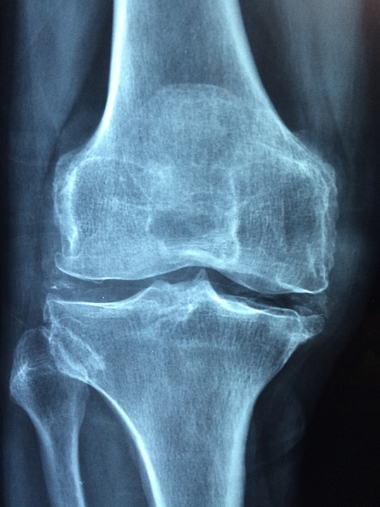 Fisioterapia Roma Artrosi del ginocchio - perdere peso è fattore chiave