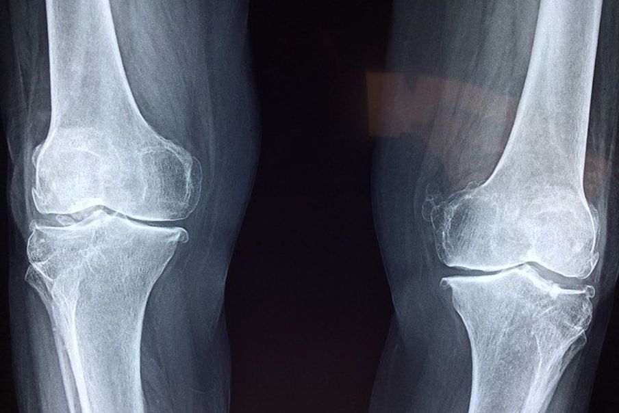 Fisioterapia Roma Recuperare da un'operazione al ginocchio